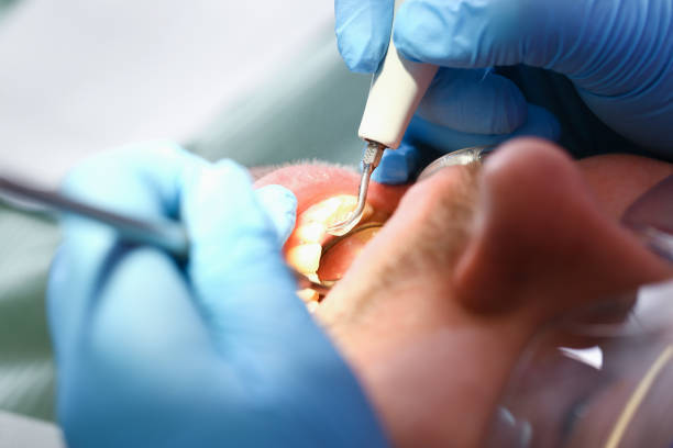 Best Emergency Root Canal Treatment in Purcellville, VA