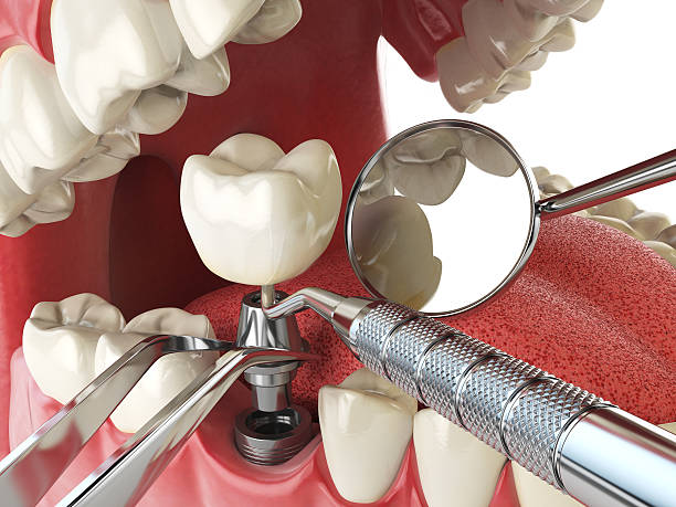 Best Emergency Treatment for Dental Infections or Abscesses in Purcellville, VA